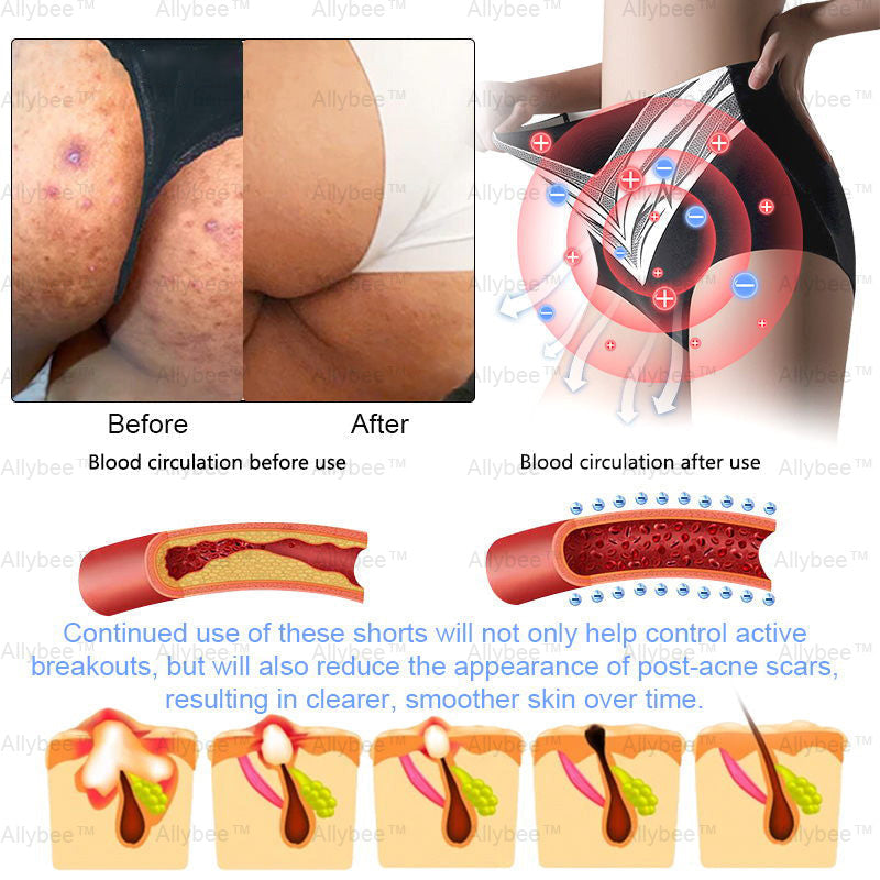 Mayo Clinic Official: Medical Grade Titanium Fiber Self-heating Tourmaline Shaping Shorts💌: Lymphedema, Varicose Veins, Scars and Stretch Marks, Gynecological Issues, Acne, Butt Sculpting