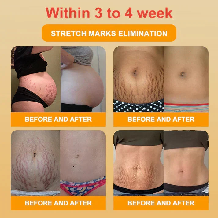 Mayo Clinic Official: Medical Grade Titanium Fiber Self-heating Tourmaline Shaping Shorts💌: Lymphedema, Varicose Veins, Scars and Stretch Marks, Gynecological Issues, Acne, Butt Sculpting