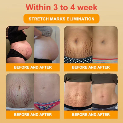 Mayo Clinic Official: Medical Grade Titanium Fiber Self-heating Tourmaline Shaping Shorts💌: Lymphedema, Varicose Veins, Scars and Stretch Marks, Gynecological Issues, Acne, Butt Sculpting