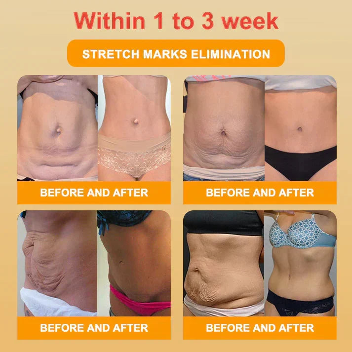 Mayo Clinic Official: Medical Grade Titanium Fiber Self-heating Tourmaline Shaping Shorts💌: Lymphedema, Varicose Veins, Scars and Stretch Marks, Gynecological Issues, Acne, Butt Sculpting