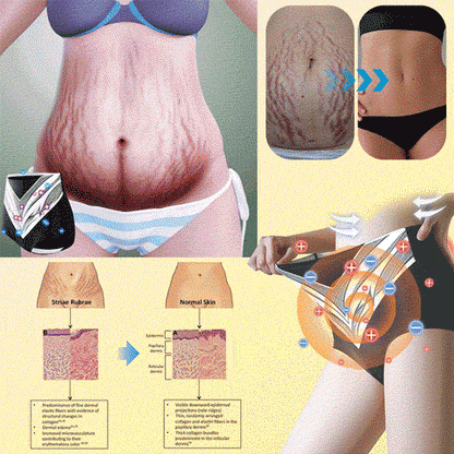 Mayo Clinic Official: Medical Grade Titanium Fiber Self-heating Tourmaline Shaping Shorts💌: Lymphedema, Varicose Veins, Scars and Stretch Marks, Gynecological Issues, Acne, Butt Sculpting